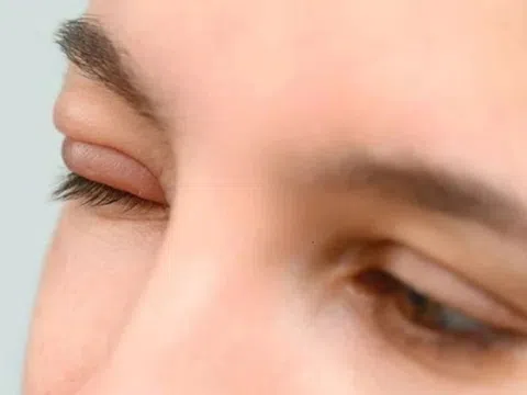 Nốt sưng nhỏ ở mắt khi nào có thể thành biến chứng lớn?