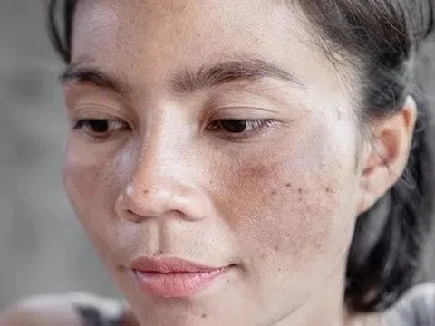 7 vấn đề về da mùa hè có thể ngăn ngừa