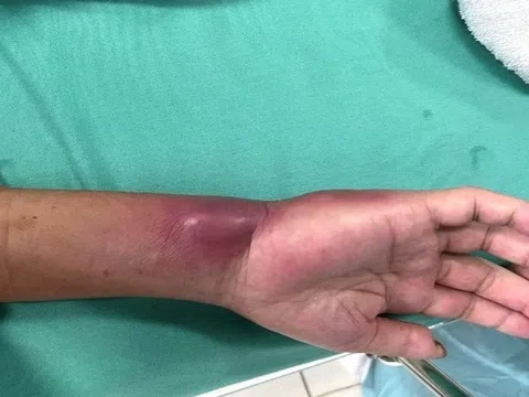 2 ca nhiễm vi khuẩn ‘ăn thịt người’ ở Đắk Lắk