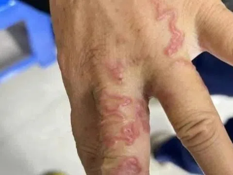 Giun bò lổm ngổm dưới da vì một thói quen ăn uống
