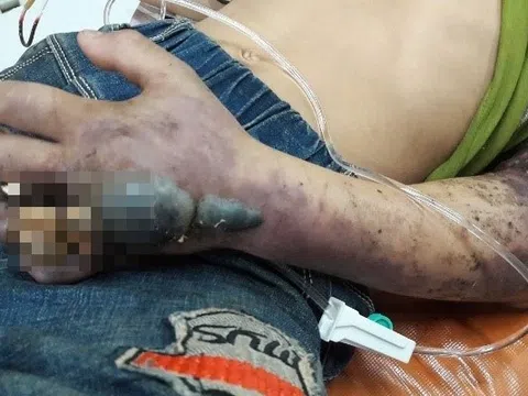 Quyết định sai khiến nạn nhân bị rắn cắn ngừng tim, tổn thương não