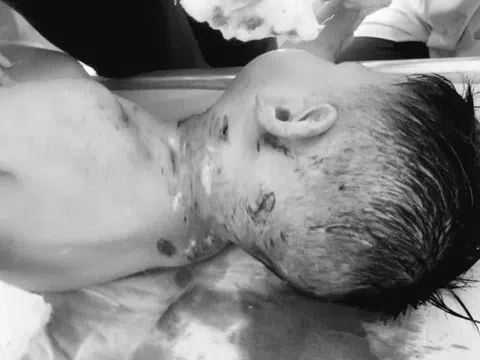 Bé trai 3 tuổi bị chó nhà hàng xóm cắn lộ xương sọ