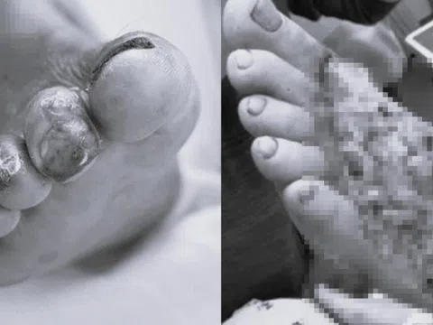 Loài vi khuẩn 'ăn thịt người' ẩn mình trong món hải sản