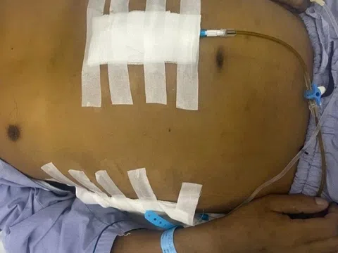 Ung thư gan vì chủ quan với một căn bệnh tưởng nhẹ