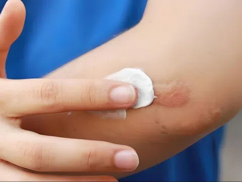 Bộ Y tế đình chỉ, thu hồi toàn quốc Gel Promed của Starmed