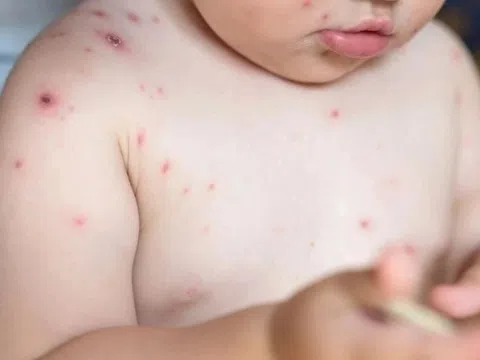 Thủy đậu dễ lây, 85% ca nhiễm từ người trong gia đình