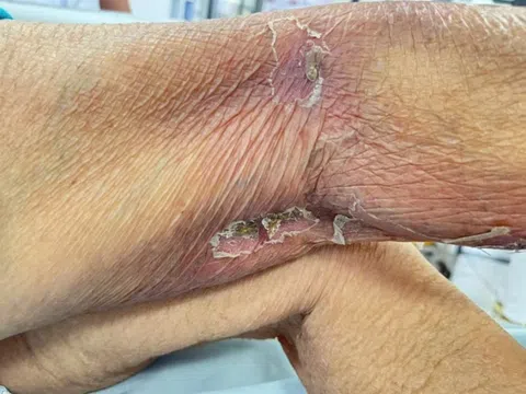 Sốc nhiễm khuẩn, ngừng tim vì vết đốt 'tử thần'