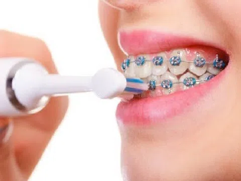 Hai lợi ích ít được biết đến của việc niềng răng