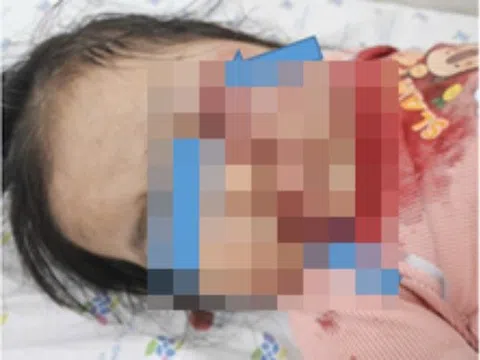 Một giây sơ suất, bé gái ngồi trước xe máy phải đi cấp cứu