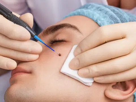 Có nên phẫu thuật tẩy nốt ruồi?