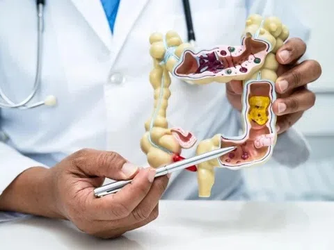 Đi khám vì bệnh tiêu hóa, bất ngờ được chẩn đoán mắc ung thư