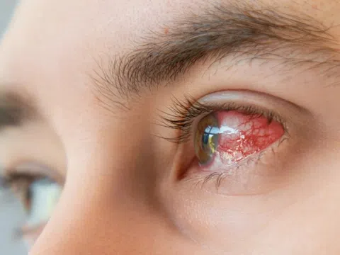 Dấu hiệu ở mắt cảnh báo thận có vấn đề, cần đi khám sớm