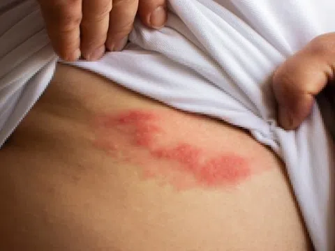Phân biệt triệu chứng giời leo và bệnh chàm