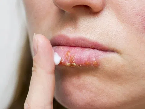 Dùng thuốc nào để điều trị chốc lở