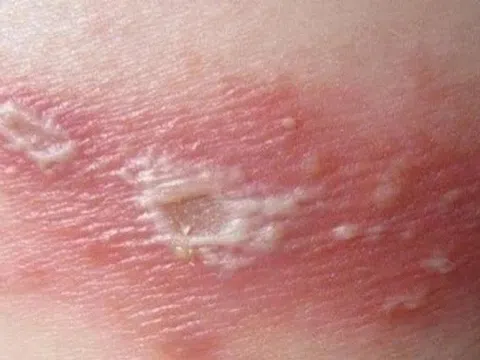 Zona gây đau đớn đến mức nào?