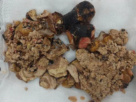 Sỏi thận phổ biến nhưng dễ bị bỏ quên