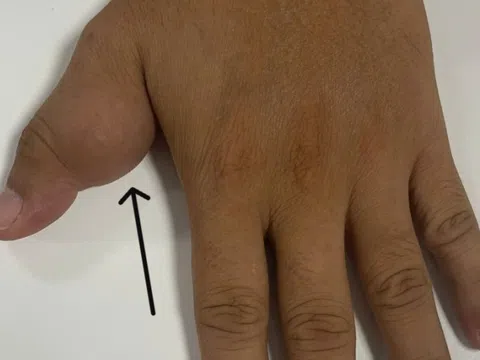 Tưởng 'thịt thừa' ở ngón tay, không ngờ là khối u ăn mòn xương