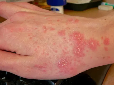 Mùa mưa lũ cảnh giác với bệnh ghẻ và cách nhận biết sớm