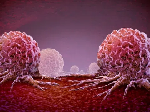 Hy vọng mới về loại ung thư nhiều người mắc nhất ở Việt Nam