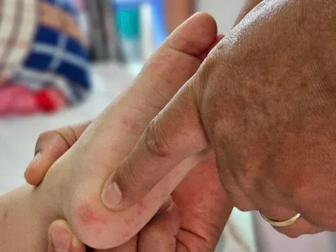 Một bệnh dự kiến tăng cao ở TP.HCM, bác sĩ khuyến cáo thận trọng