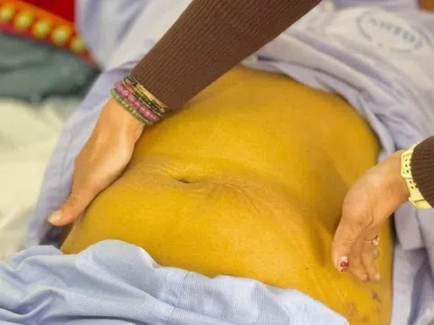 Mắc ung thư ở tuổi 25 vì chủ quan với căn bệnh gan nguy hiểm