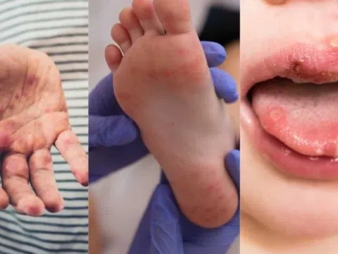 Bệnh tay chân miệng ở trẻ em: Dấu hiệu, nguyên nhân và cách điều trị