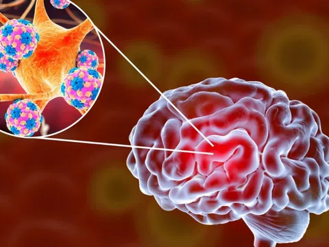 Nhận biết sớm các biểu hiện viêm màng não