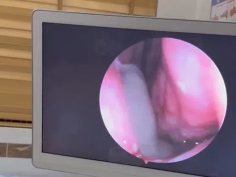 Chảy máu mũi liên tục, đi khám phát hiện lý do không ai ngờ
