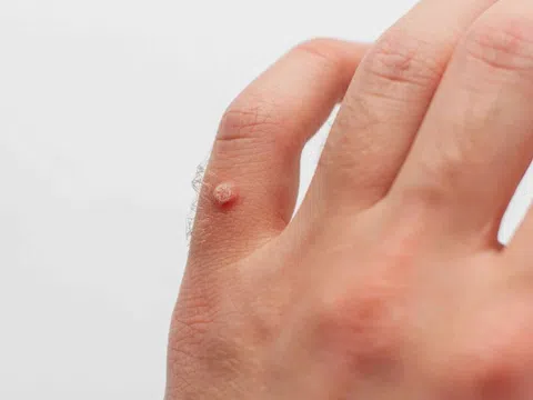 Triệu chứng nhận biết nhiễm virus HPV