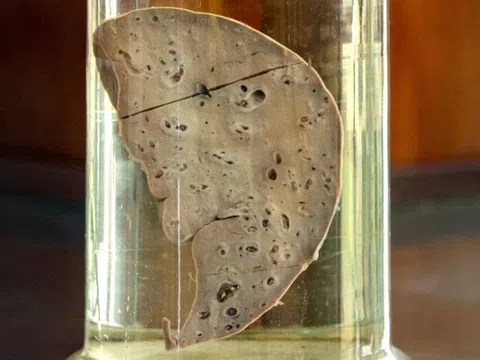 Thói quen ăn uống của nhiều người dễ gây tổn thương gan