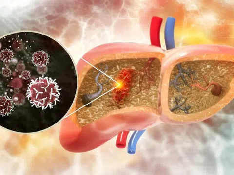 Cách 'tổ sâu' ung thư phá hủy lá gan