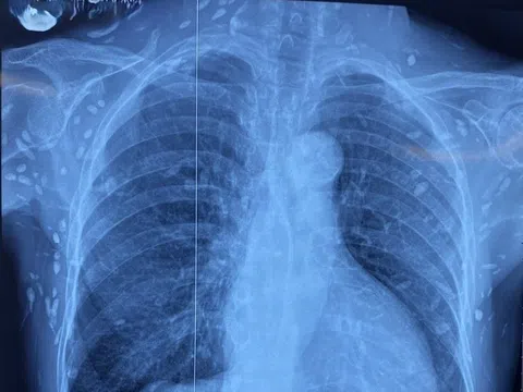 Món 'khoái khẩu' khiến nhiều người bị sán làm tổ khắp cơ thể