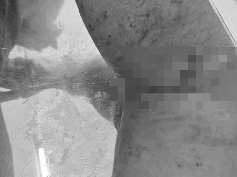 Nối thành công động mạch cánh tay cho bệnh nhân ở Phú Quốc