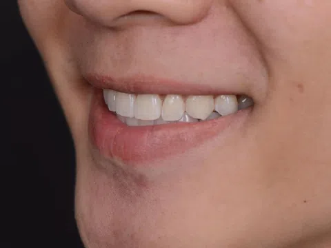 Bác sĩ hướng dẫn người niềng răng vệ sinh khay niềng sạch bóng tại nhà