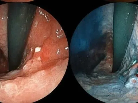 Số ca mắc ung thư ở TP.HCM ngày càng tăng