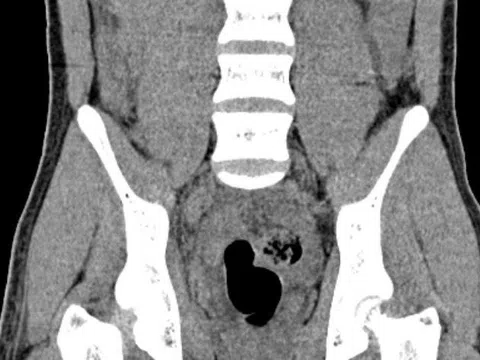 Cậu bé 14 tuổi bị liệt hai chân do đứt tủy sống sau tai nạn giao thông