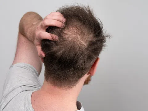 Loại đồ uống làm tăng nguy cơ hói đầu ở nam giới