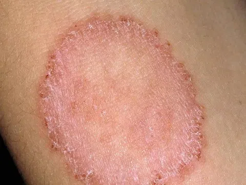 Dấu hiệu nổi bật của bệnh lác đồng tiền và cách xử trí