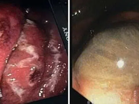 Bác sĩ sốc khi phát hiện dạ dày bệnh nhân gần như bị ăn mòn