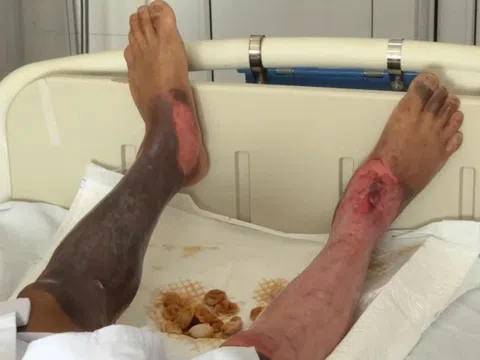 Người đàn ông bị bỏng thương tâm dù không chạm vào dây điện