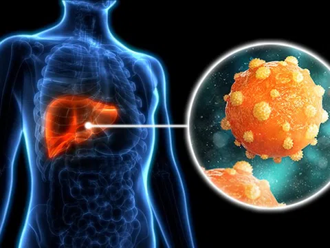 Ba chứng viêm âm thầm châm ngòi cho ung thư