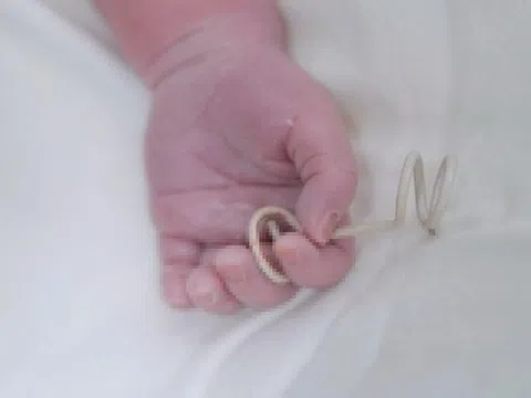 Chiếc ống nhỏ cứu em bé trong bụng mẹ