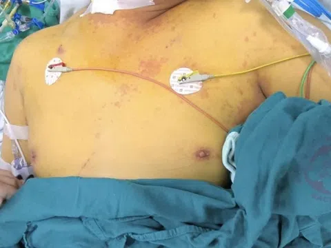 Da vàng như nghệ, suy gan thận vì vi khuẩn lan theo dòng nước