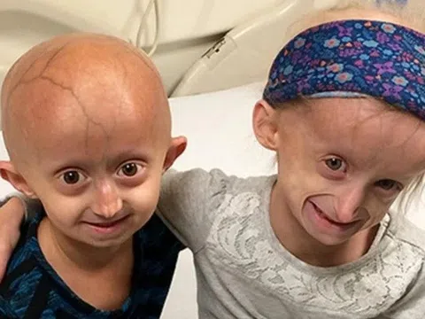 Bí ẩn gene lỗi khiến trẻ nhỏ già đi như người già