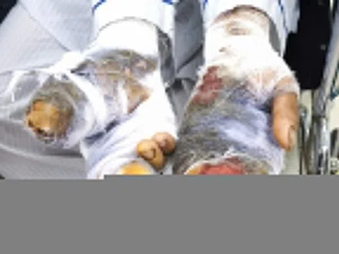 Chó nhà lao vào cắn nát hai bàn tay của chủ khi đang cho ăn