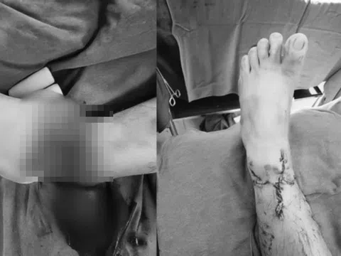 Thanh niên 25 tuổi nhập viện với bàn chân gần đứt rời