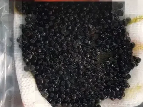 Hàng trăm viên sỏi ken đặc trong túi mật của người phụ nữ