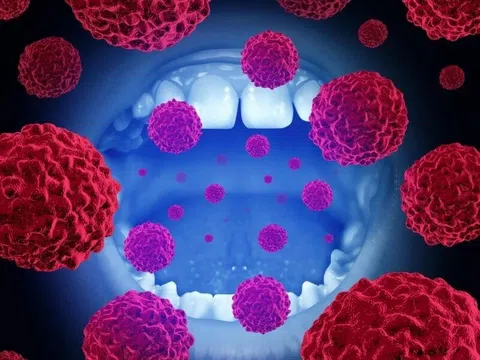 Triệu chứng âm thầm cảnh báo ung thư miệng