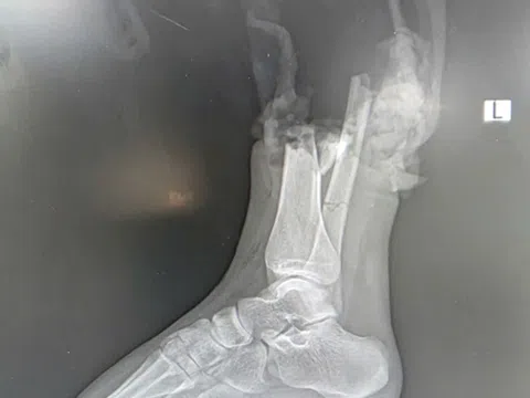 Nối chân bị đứt lìa do va chạm mô tô phân phối lớn cho nữ sinh