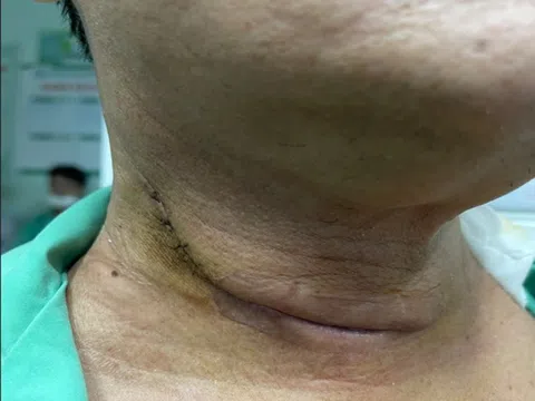 Đi khám khàn tiếng, bàng hoàng phát hiện mắc 2 loại ung thư